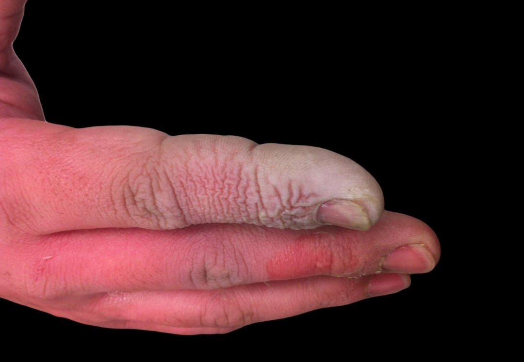 接觸了氫氟酸的手部